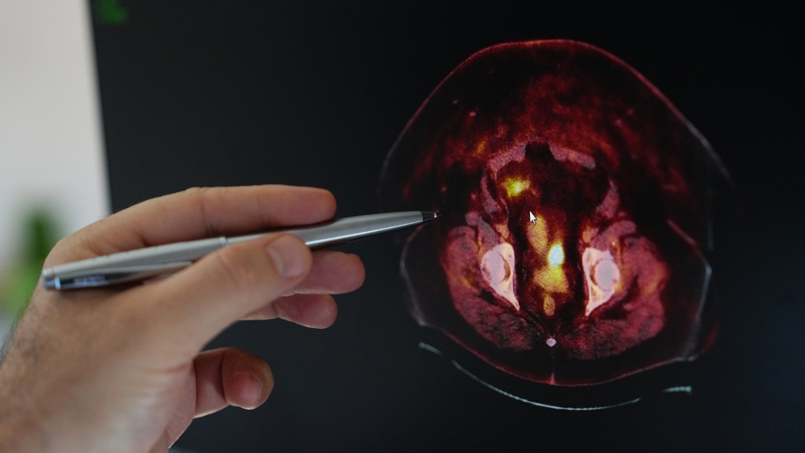 uzmanindan kadinlara kritik uyari obezite rahim kanseri riskini artiriyor IJYSumTN